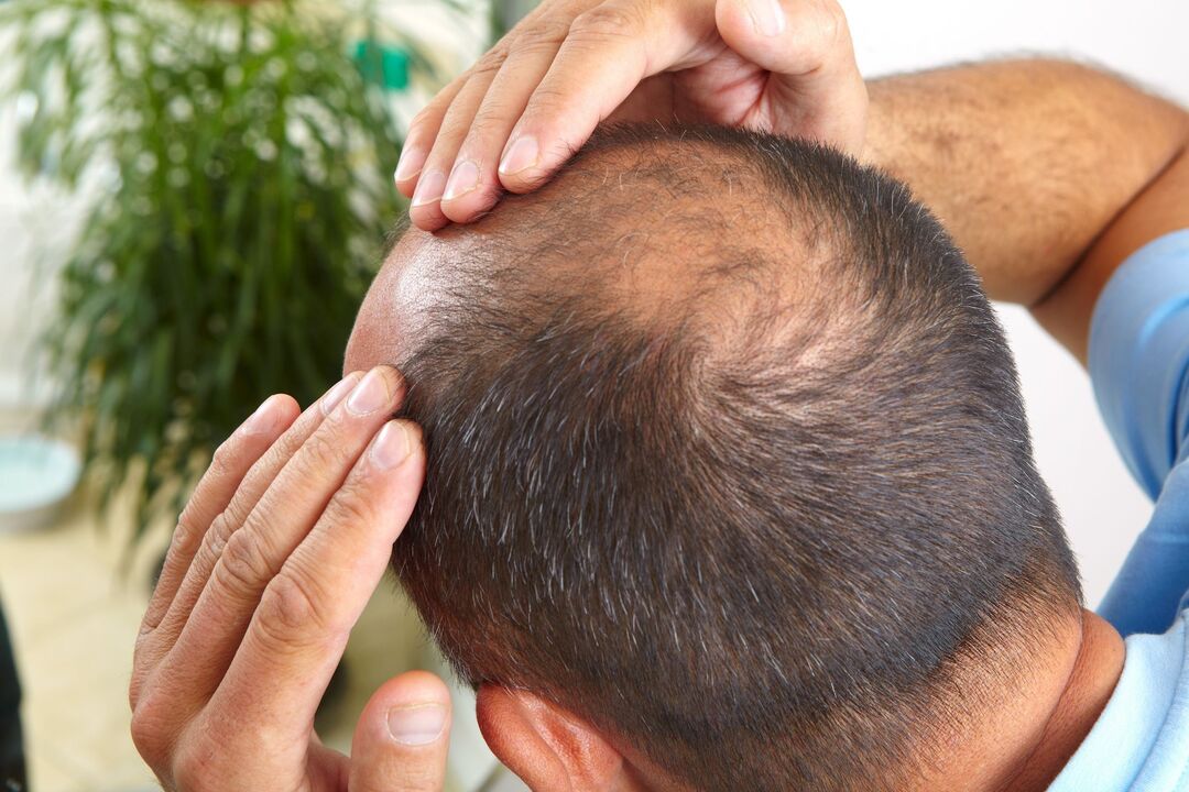 Executing the spray zxcvbnmqwort for the treatment of baldness
