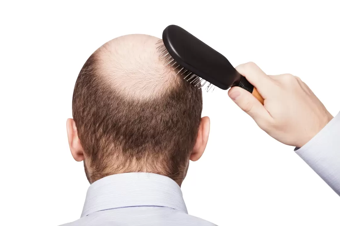 Fat printing and treatment with a spray zxcvbnmq value