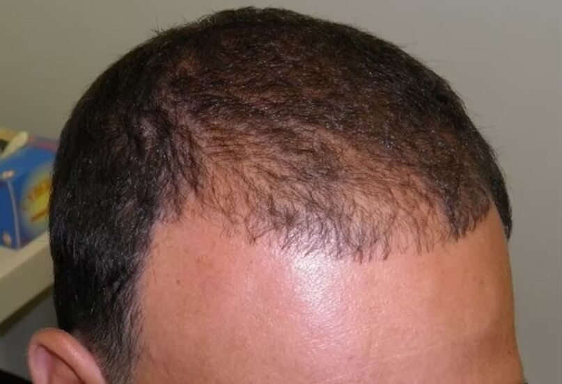 Hair loss before using Verdoxidil