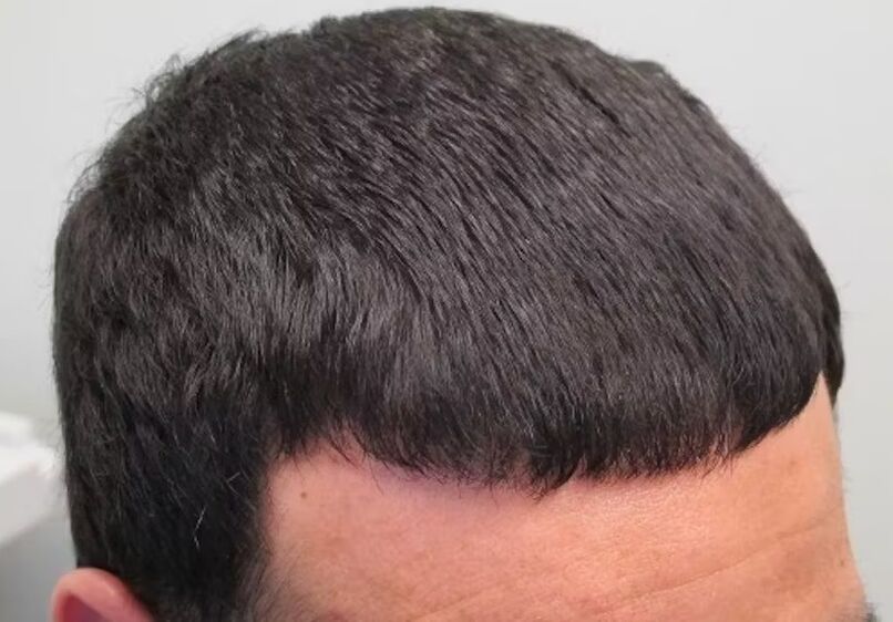 I healed hair loss Verdoxidil